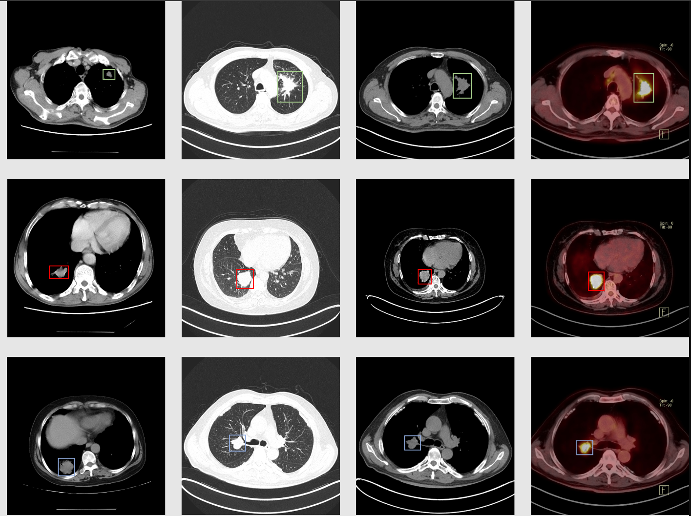 Medical Image Segmentation